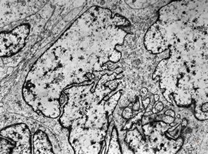 M,5y. | rhabdomyosarcoma vestibuli oris